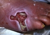 rani infestate cu larve la un pacient de 67 de ani din dambovita