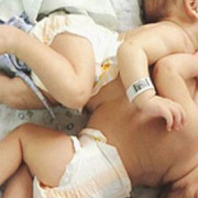siamezele nascute de craciun sunt in continuare in spital