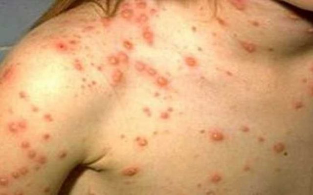Prahova se numără printre județele cele mai afectate de rujeolă